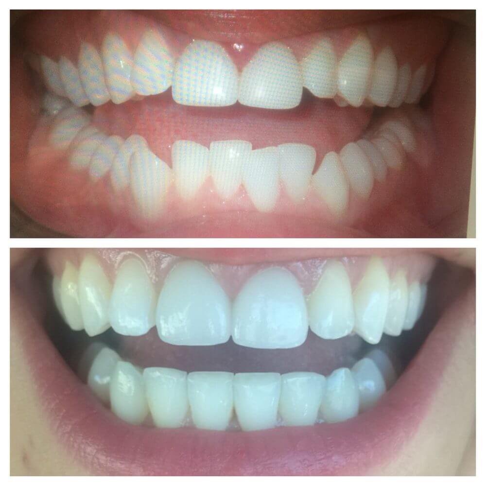 Before and After Invisalign